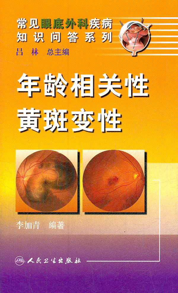 年龄相关性黄斑变性