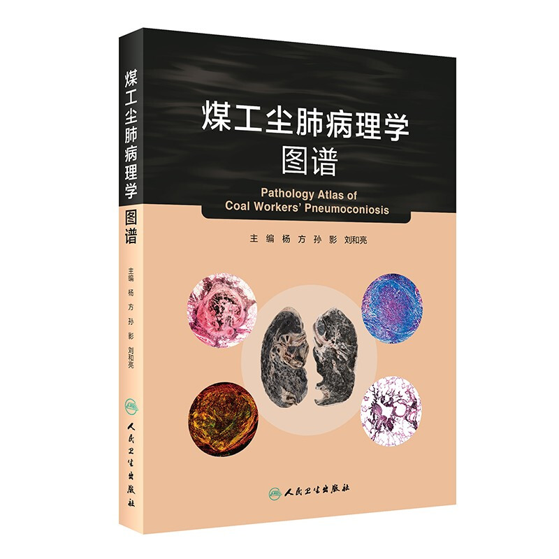 煤工尘肺病理学图谱(3)