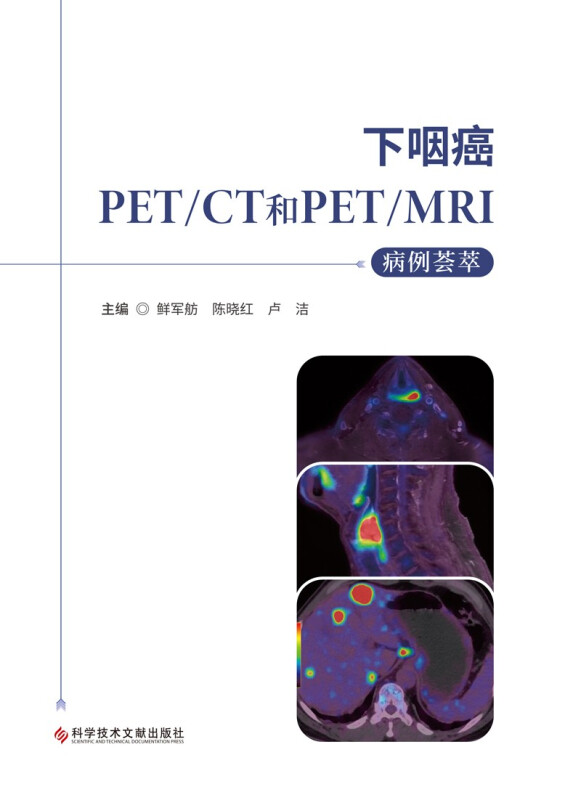 下咽癌PET\CT和PET\MRI病例荟萃