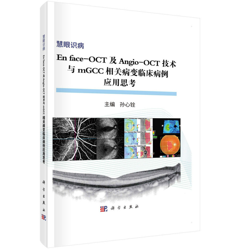 En face-OCT及Angio-OCT技术与MGCC相关病变临床病例应用思考